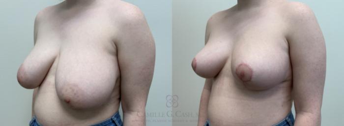 Before & After Breast Reduction Case 448 View #2 View in Houston, TX