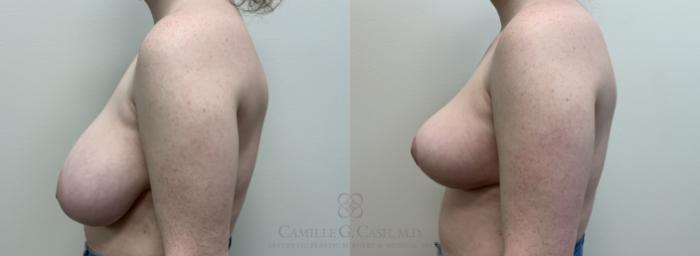 Before & After Breast Reduction Case 448 View #3 View in Houston, TX