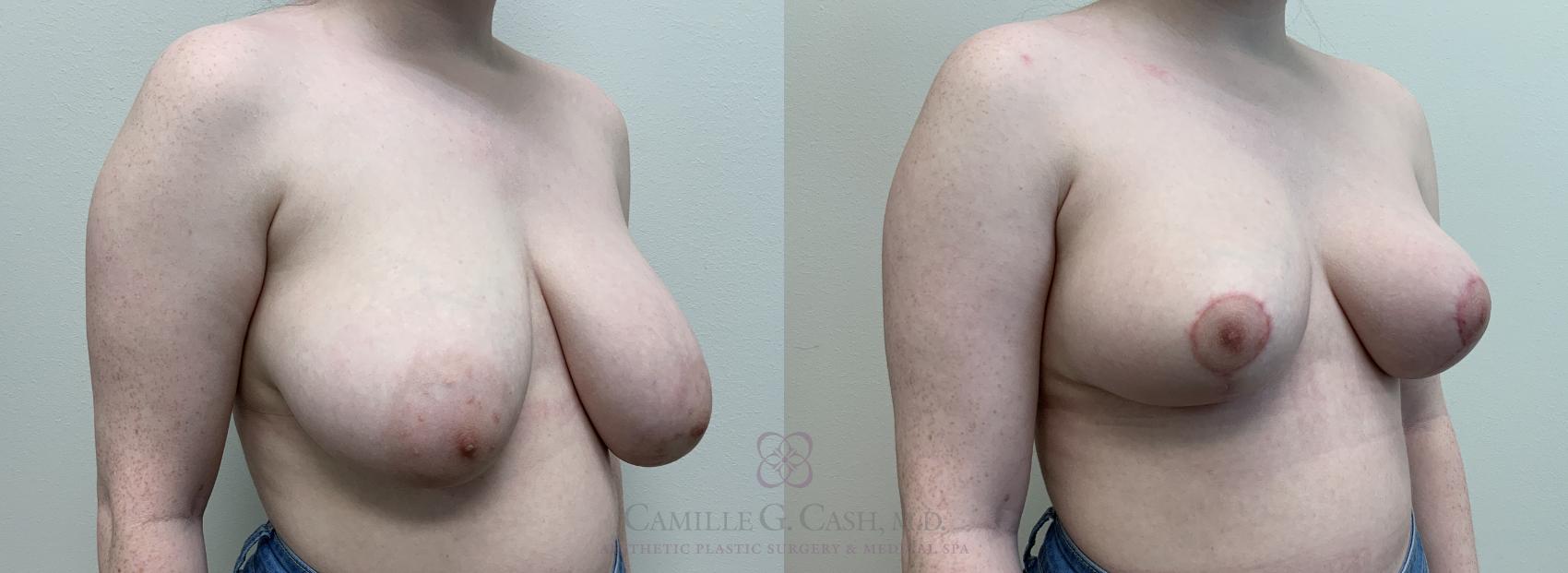 Before & After Breast Reduction Case 448 View #4 View in Houston, TX