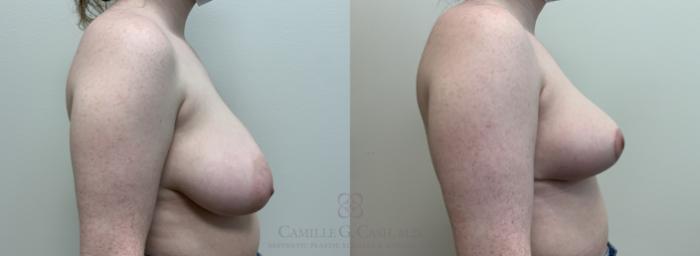 Before & After Breast Reduction Case 448 View #5 View in Houston, TX