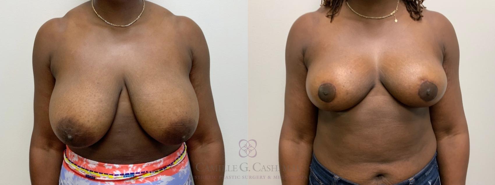 Before & After Breast Reduction Case 476 Front View in Houston, TX