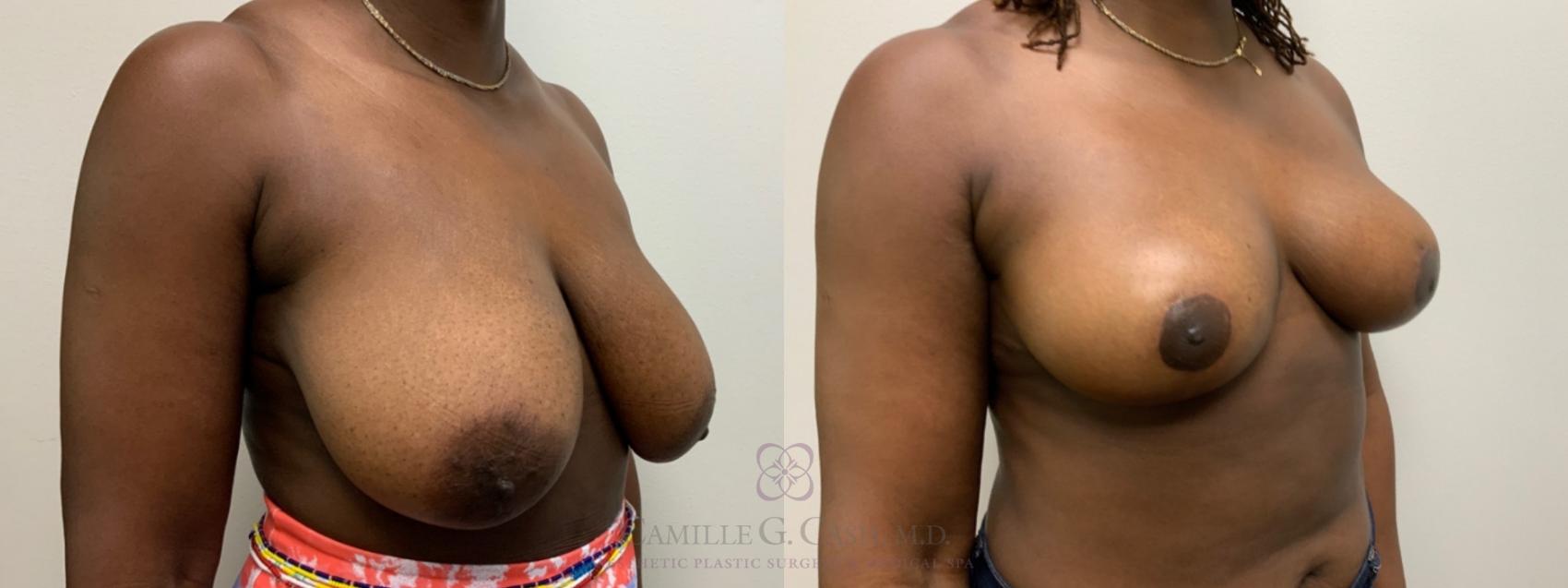 Before & After Breast Reduction Case 476 Left Oblique View in Houston, TX
