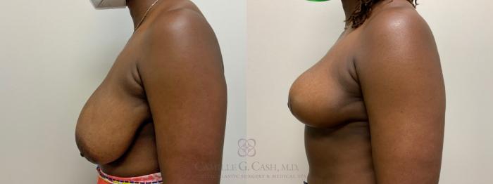 Before & After Breast Reduction Case 476 Left Side View in Houston, TX