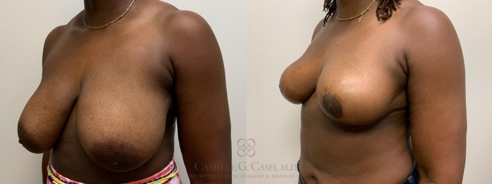 Before & After Breast Reduction Case 476 Right Oblique View in Houston, TX
