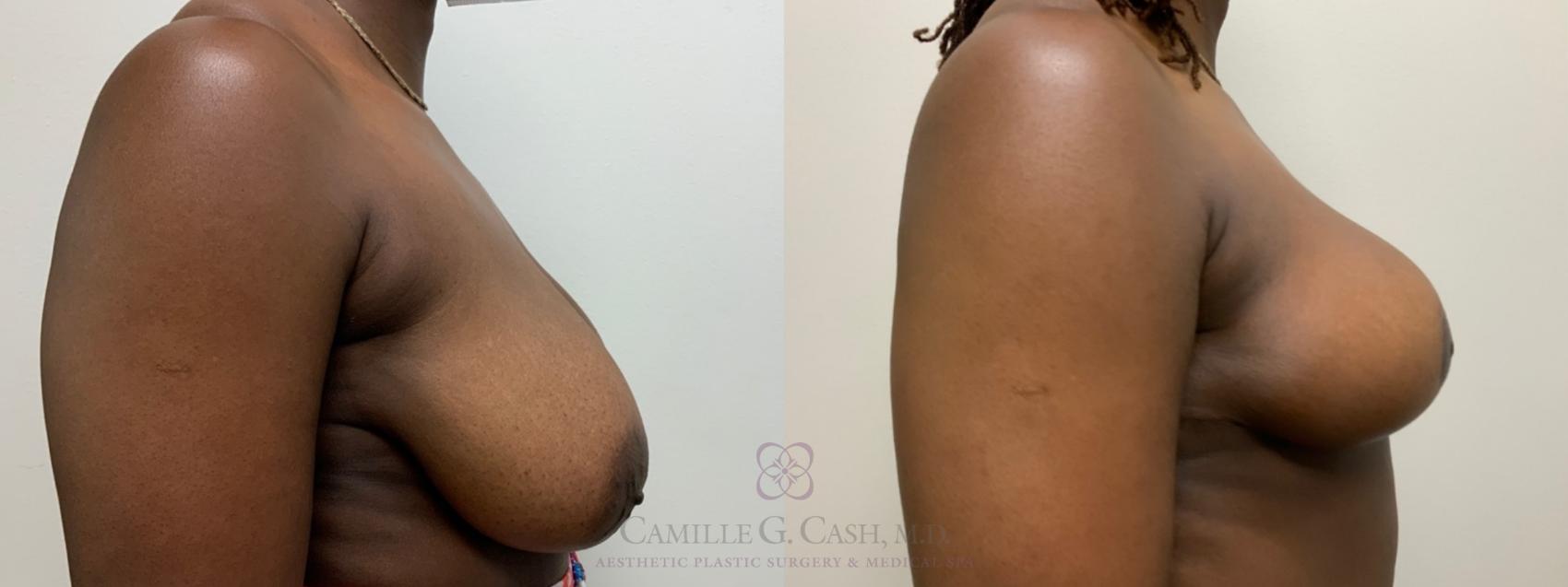Before & After Breast Reduction Case 476 Right Side View in Houston, TX
