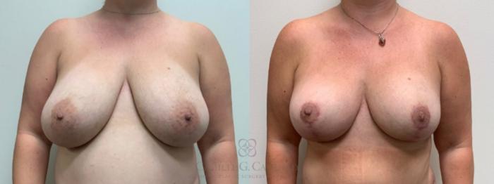 Before & After Breast Reduction Case 503 Front View in Houston, TX