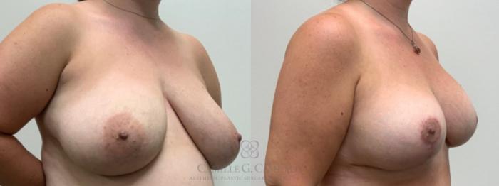 Before & After Breast Reduction Case 503 Left Oblique View in Houston, TX