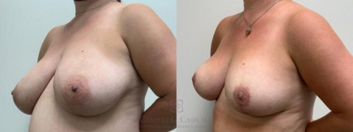 Before & After Breast Reduction Case 503 Left Side View in Houston, TX