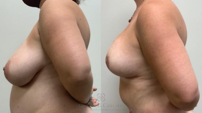 Before & After Breast Reduction Case 503 Right Side View in Houston, TX