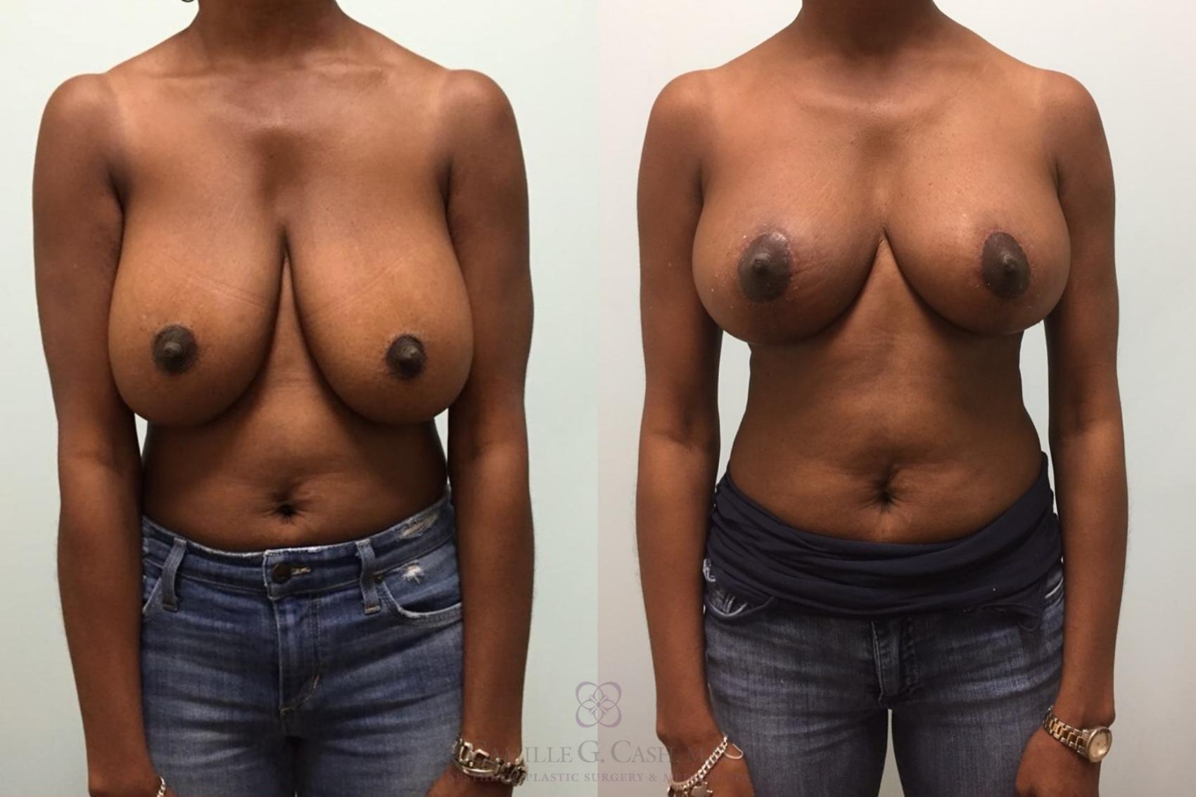 Before & After Breast Reduction Case 510 6 week after View in Houston, TX