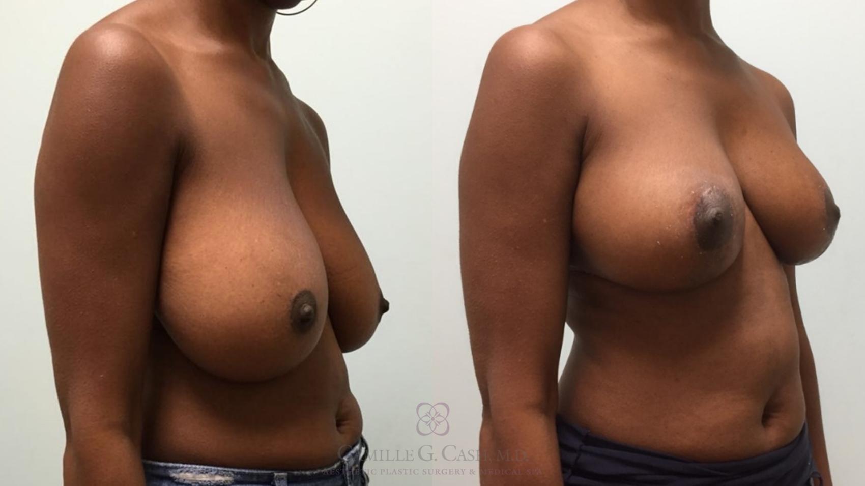 Before & After Breast Reduction Case 510 Left Oblique View in Houston, TX