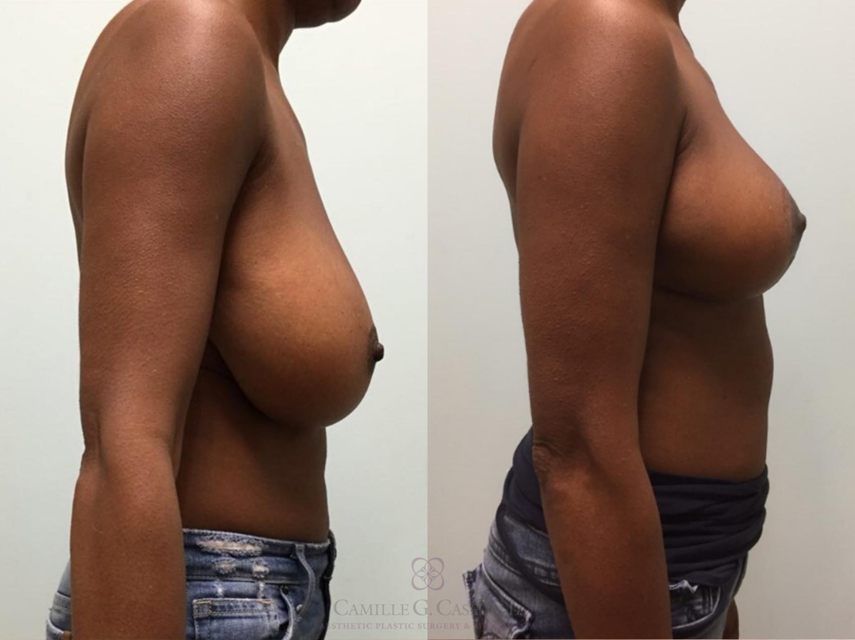 Before & After Breast Reduction Case 510 Left Side View in Houston, TX
