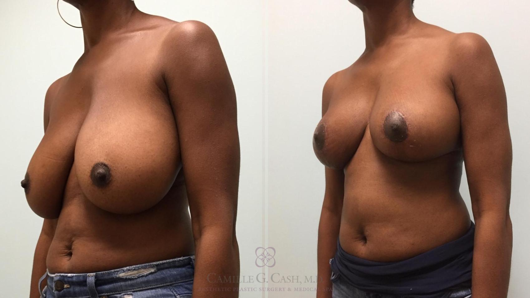 Before & After Breast Reduction Case 510 Right Oblique View in Houston, TX