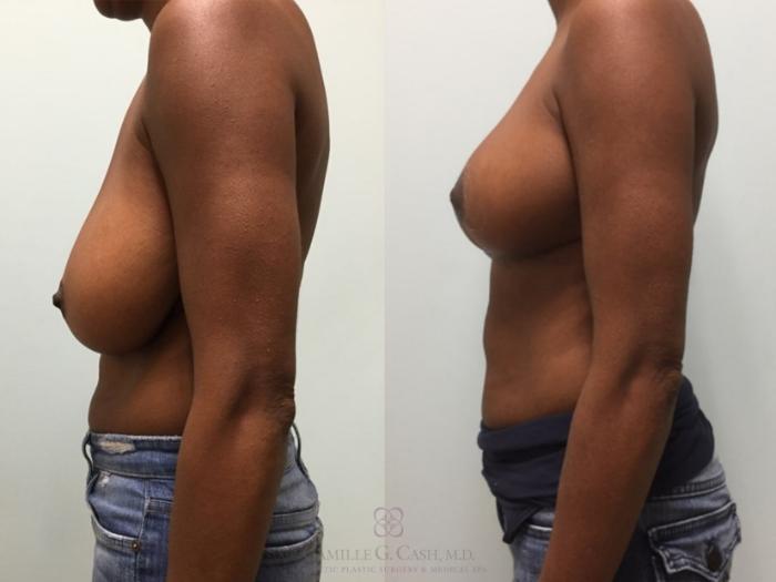 Before & After Breast Reduction Case 510 Right Side View in Houston, TX