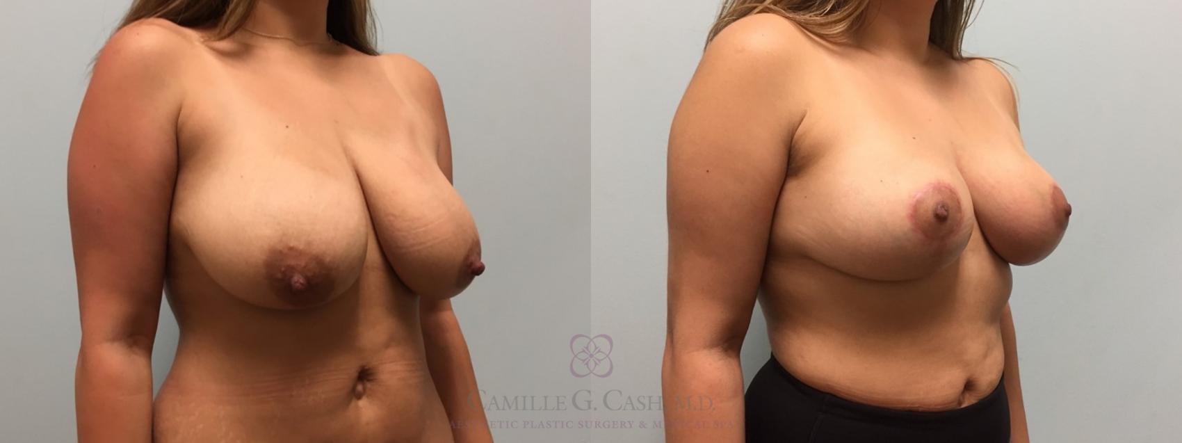Before & After Breast Reduction Case 517 Left Oblique View in Houston, TX