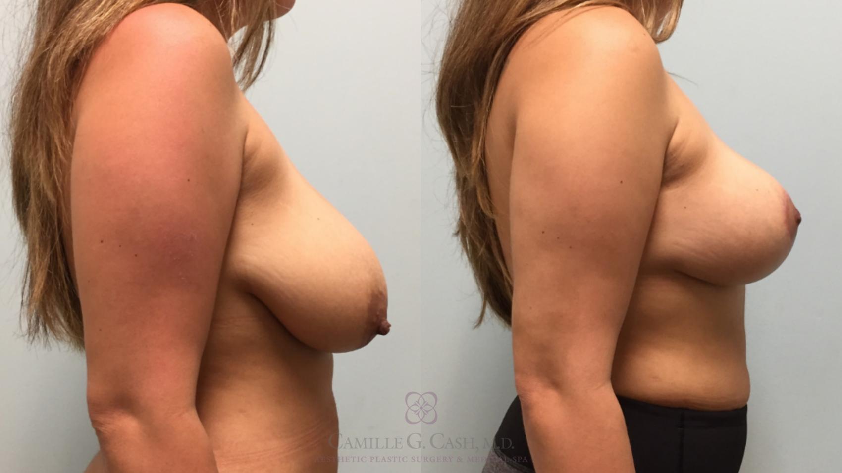 Before & After Breast Reduction Case 517 Left Side View in Houston, TX