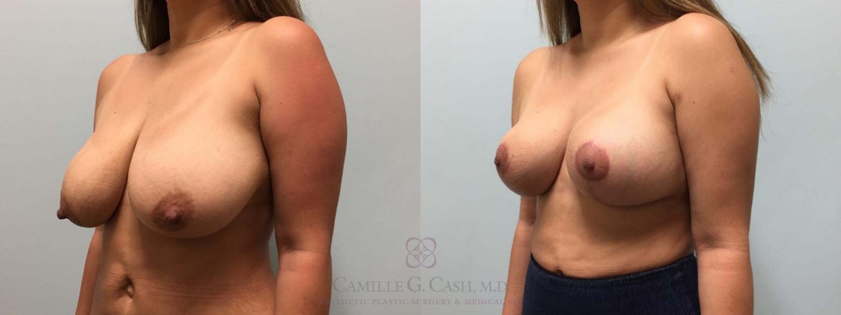 Before & After Breast Reduction Case 517 Right Oblique View in Houston, TX