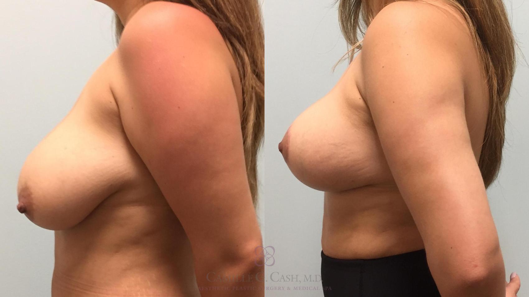 Before & After Breast Reduction Case 517 Right Side View in Houston, TX