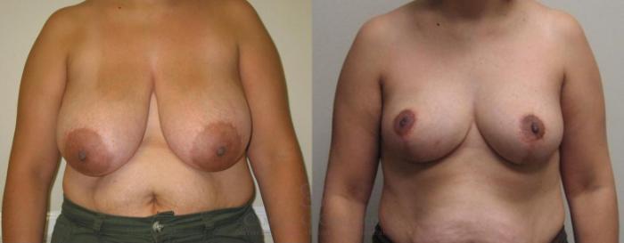 Before & After Breast Reduction Case 52 View #1 View in Houston, TX