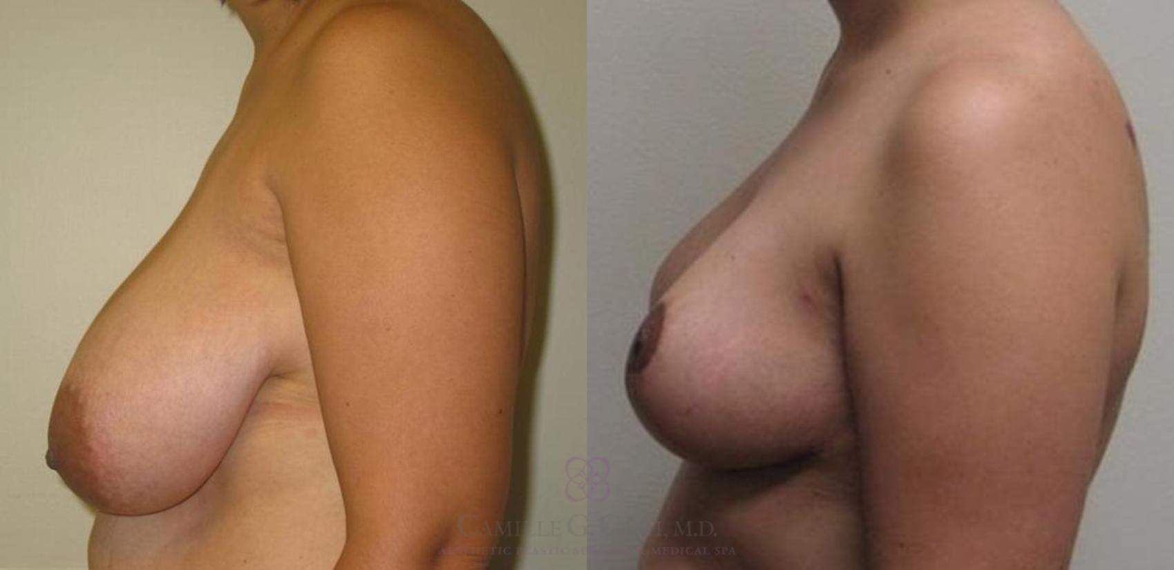 Before & After Breast Reduction Case 52 View #2 View in Houston, TX