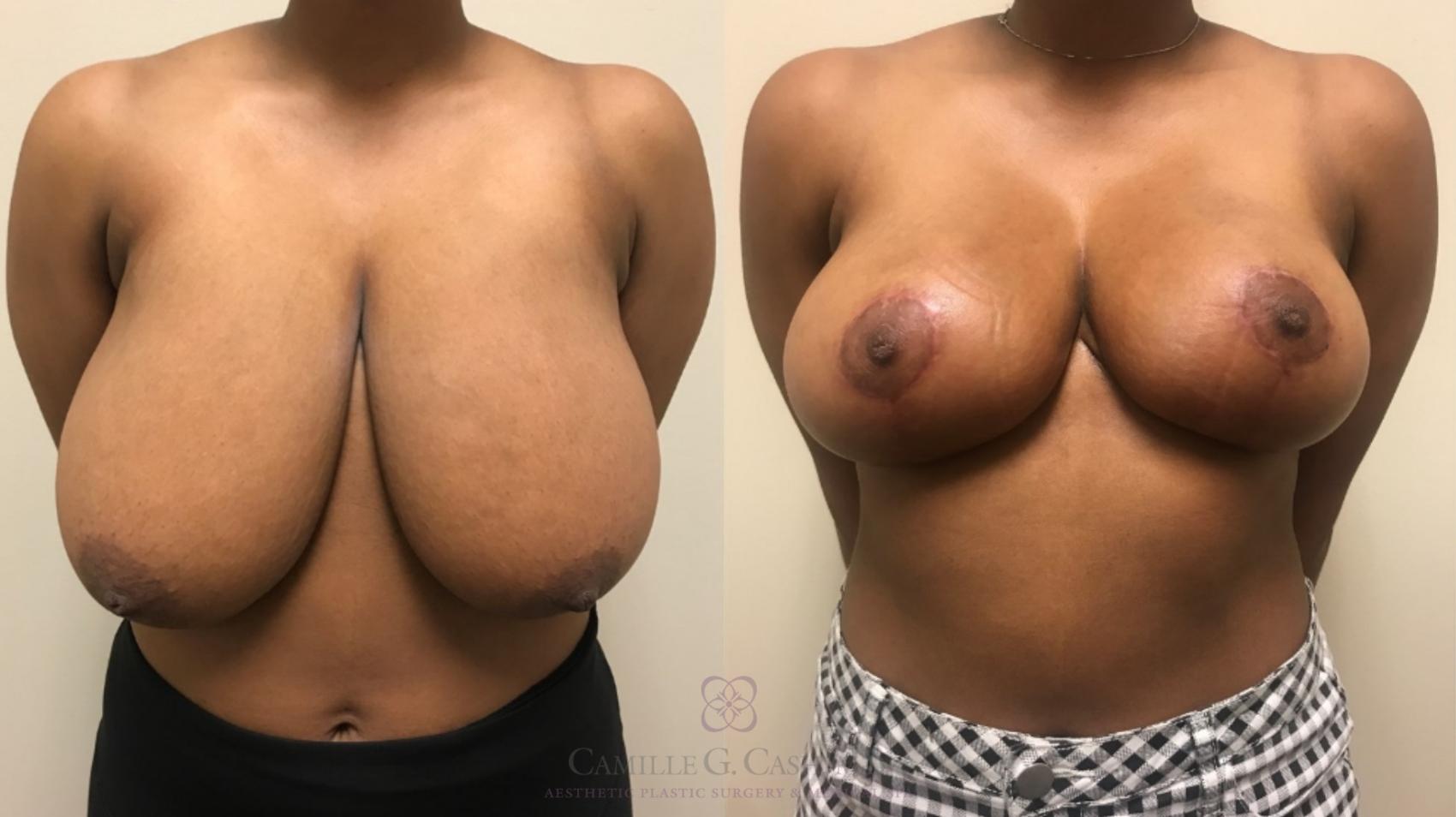 Before & After Breast Reduction Case 533 Front View in Houston, TX
