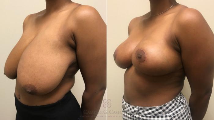 Before & After Breast Reduction Case 533 Left Oblique View in Houston, TX