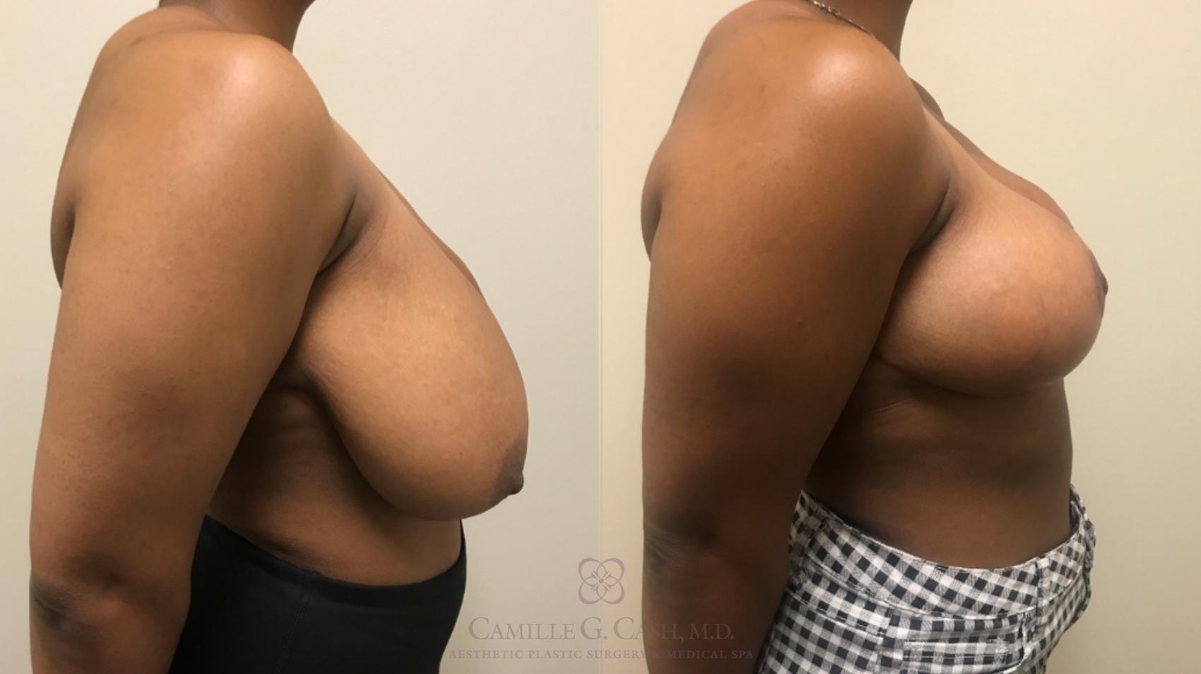 Before & After Breast Reduction Case 533 Left Side View in Houston, TX
