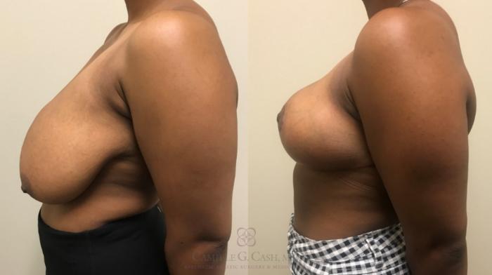 Before & After Breast Reduction Case 533 Right Side View in Houston, TX