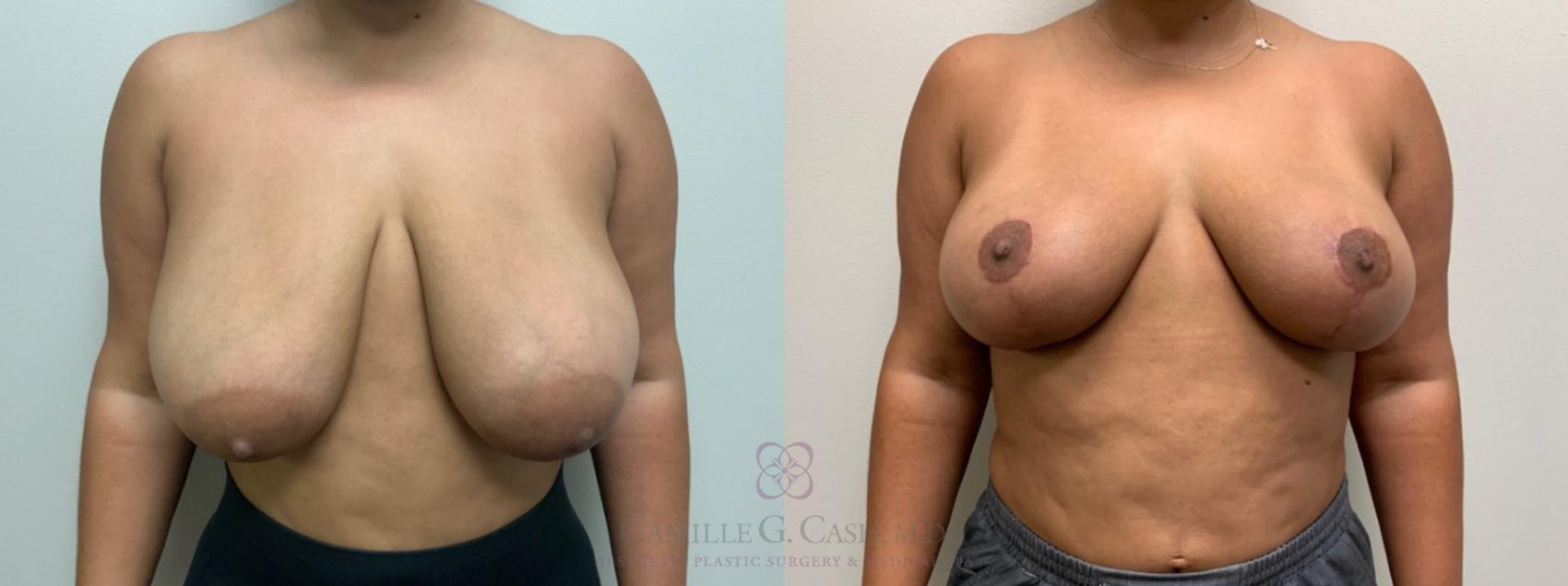 Before & After Breast Reduction Case 538 Front View in Houston, TX