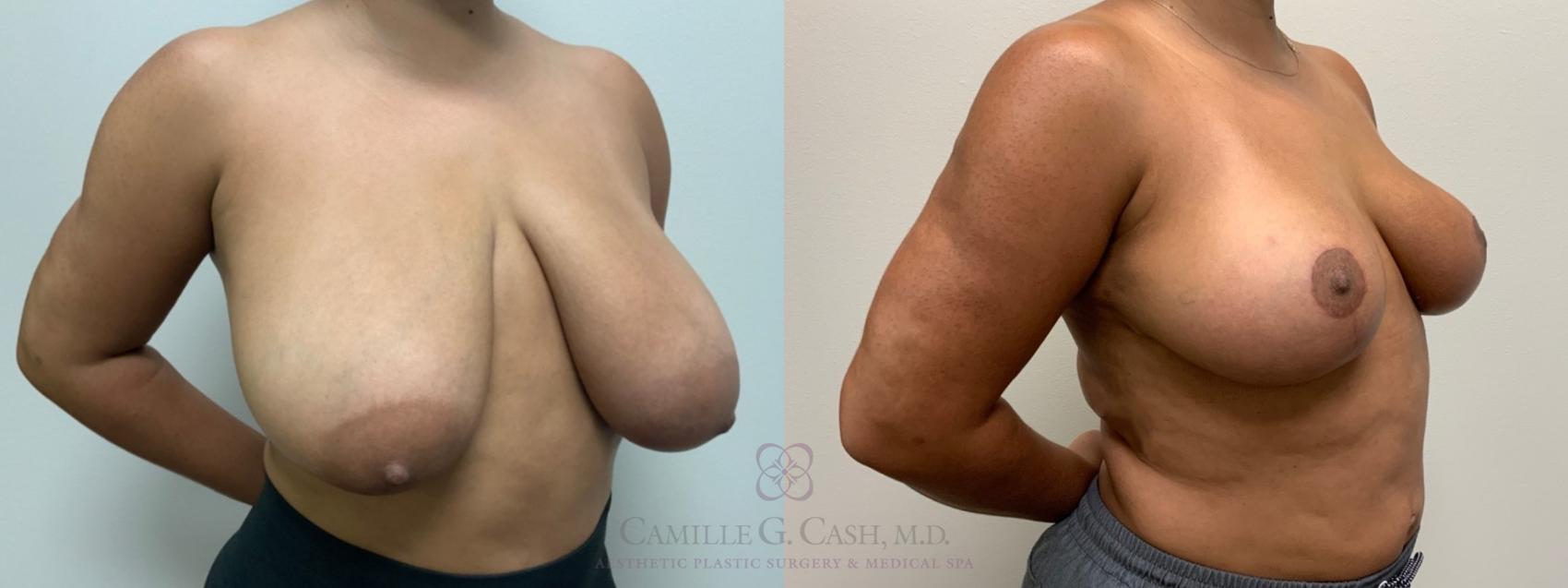 Before & After Breast Reduction Case 538 Left Oblique View in Houston, TX