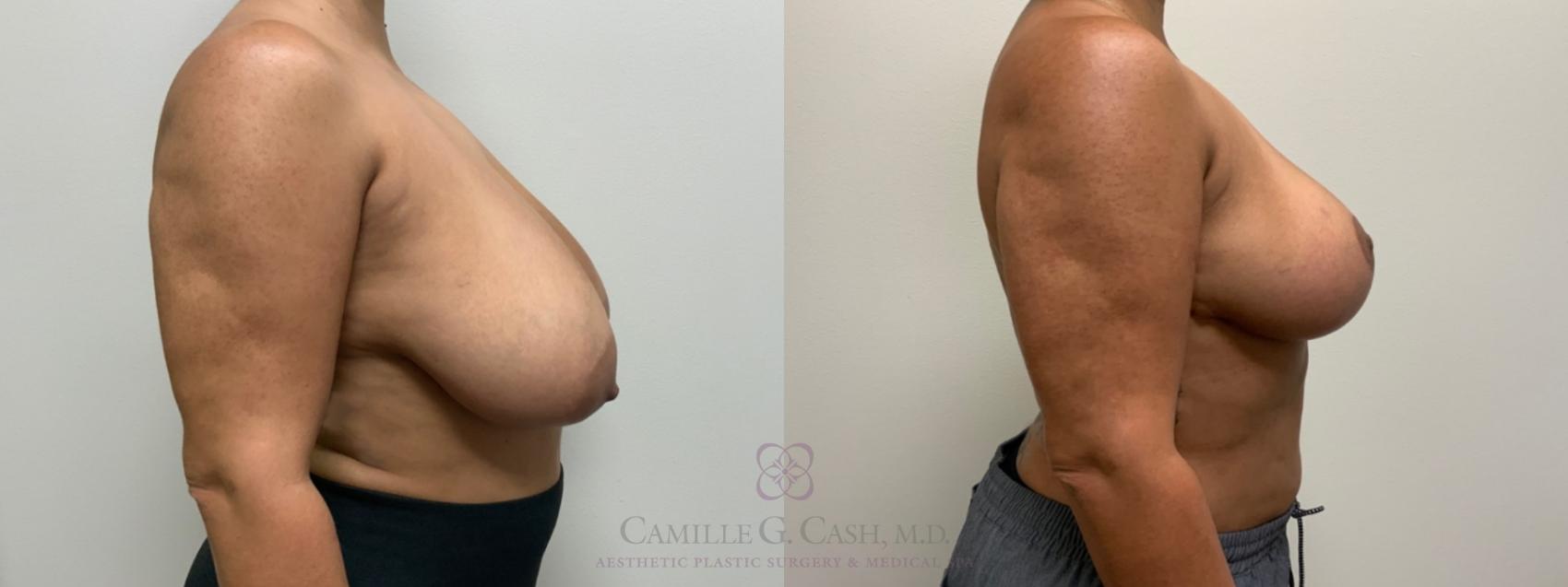Before & After Breast Reduction Case 538 Left Side View in Houston, TX