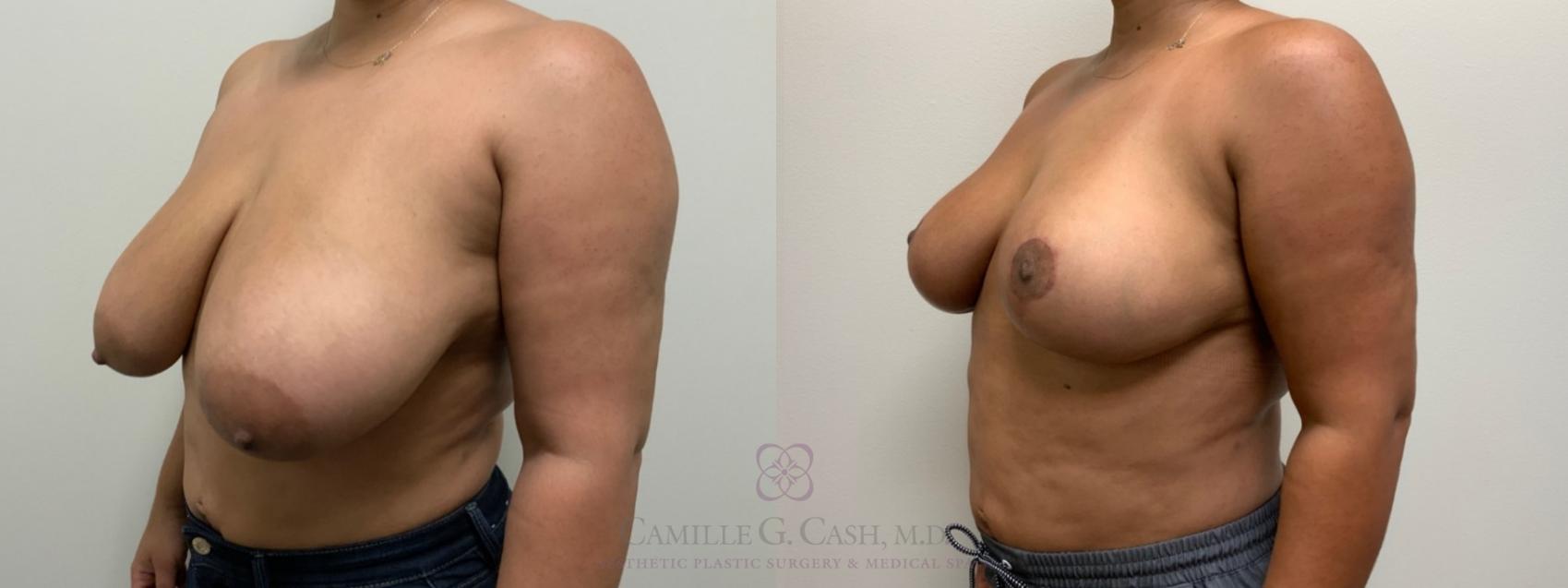 Before & After Breast Reduction Case 538 Right Oblique View in Houston, TX