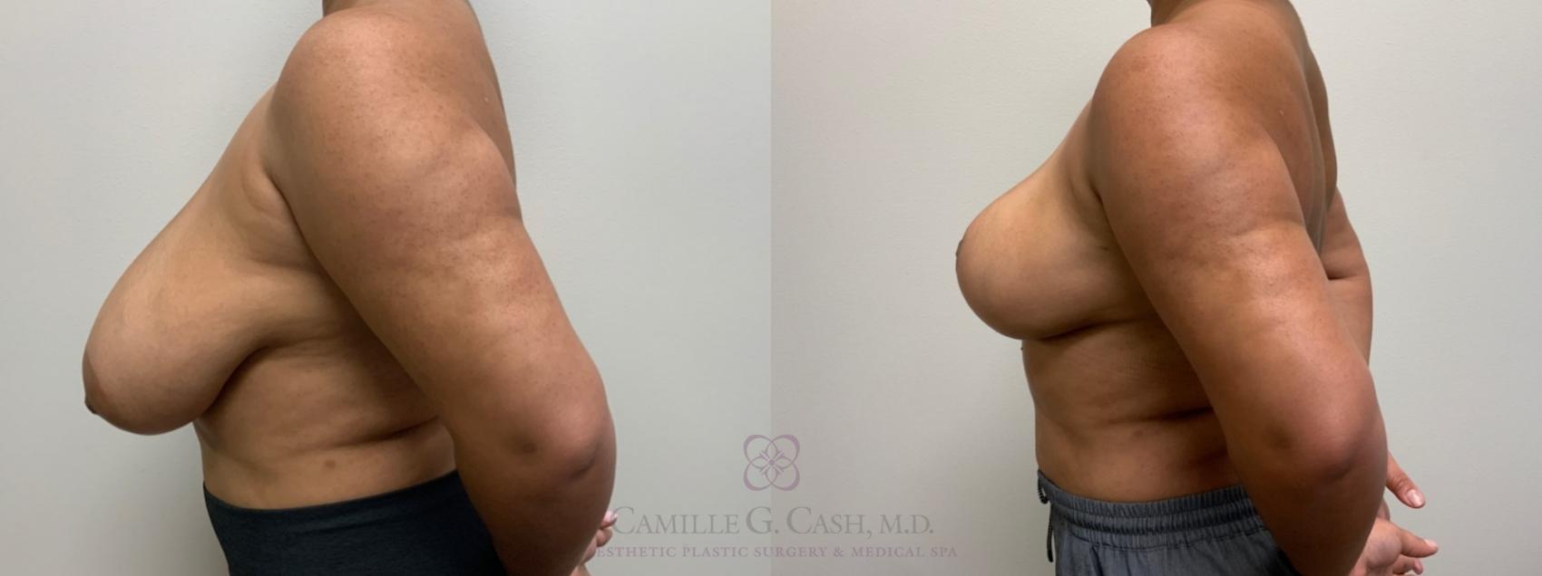 Before & After Breast Reduction Case 538 Right Side View in Houston, TX