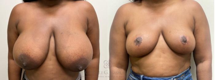 Before & After Breast Reduction Case 542 before and 4 front View in Houston, TX