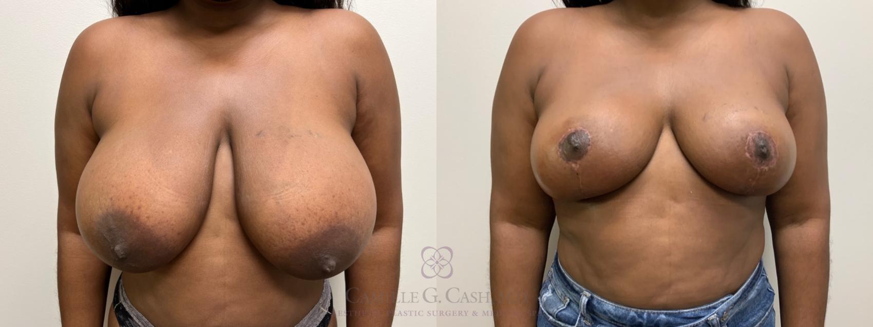 Before & After Breast Reduction Case 542 Front View in Houston, TX