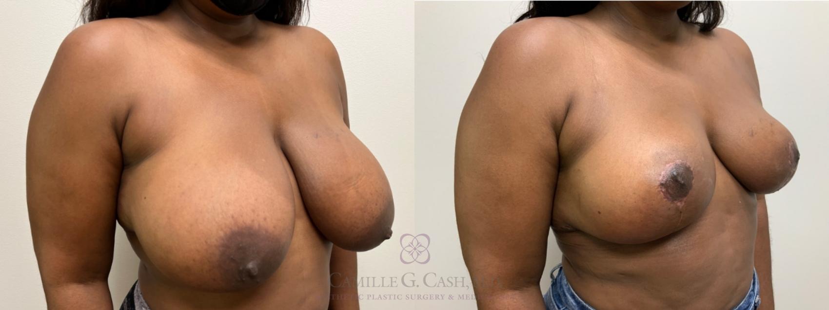 Before & After Breast Reduction Case 542 Left Oblique View in Houston, TX