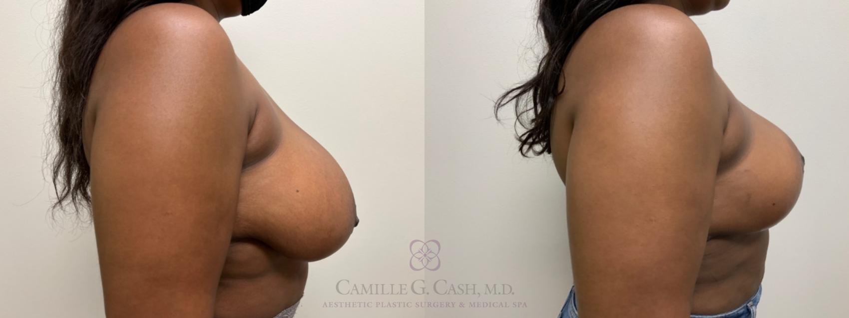 Before & After Breast Reduction Case 542 Left Side View in Houston, TX