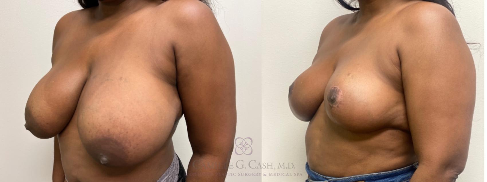 Before & After Breast Reduction Case 542 oblique 4 months View in Houston, TX