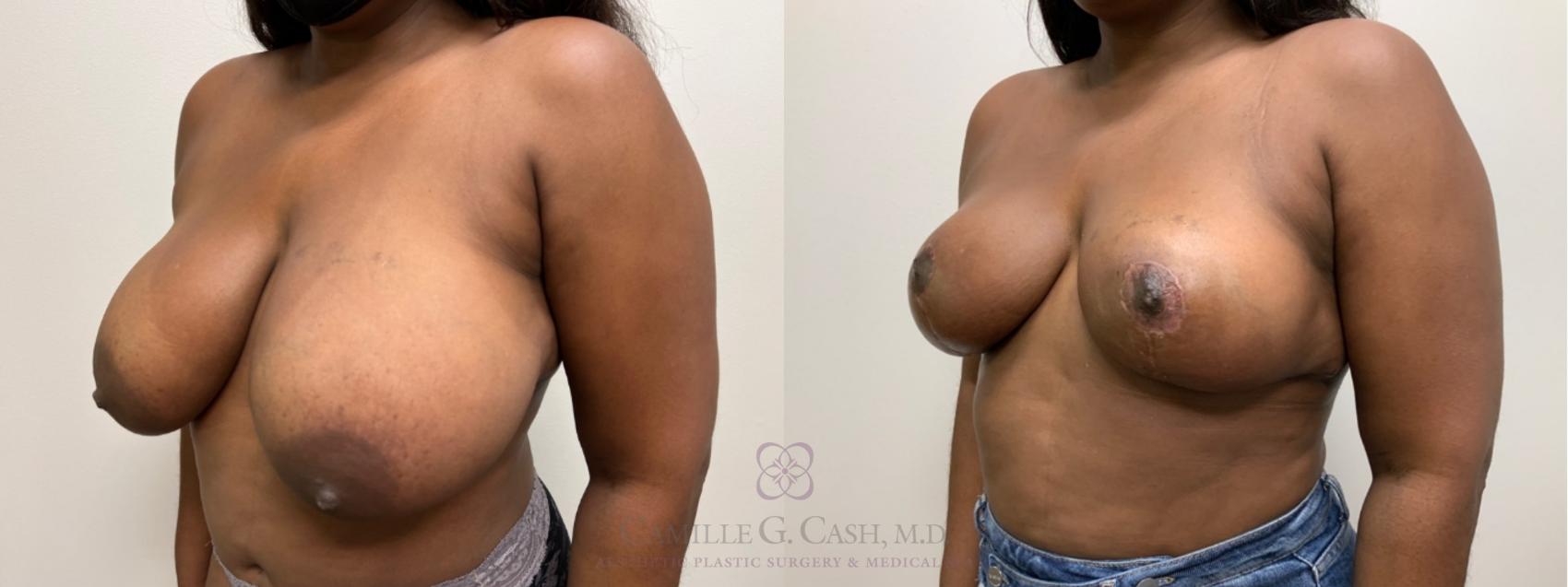 Before & After Breast Reduction Case 542 Right Oblique View in Houston, TX