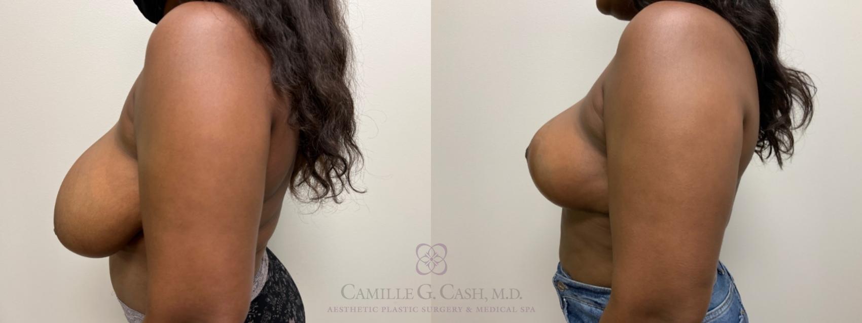 Before & After Breast Reduction Case 542 Right Side View in Houston, TX