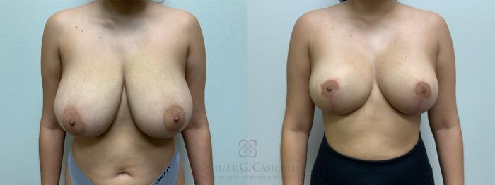 Before & After Breast Reduction Case 544 front 4 mo View in Houston, TX