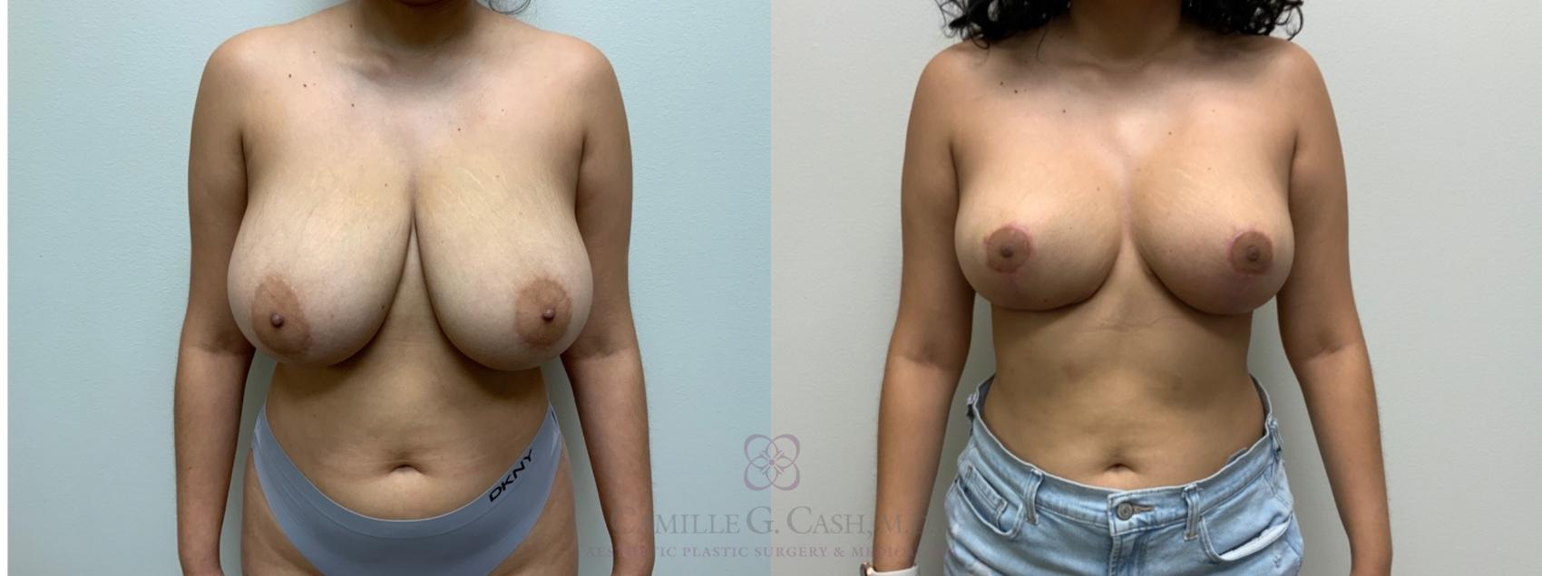 Before & After Breast Reduction Case 544 Front View in Houston, TX