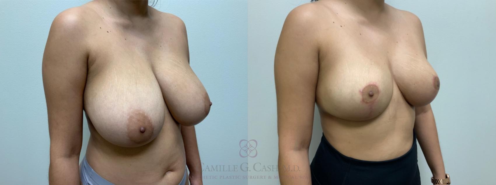 Before & After Breast Reduction Case 544 Left Oblique View in Houston, TX