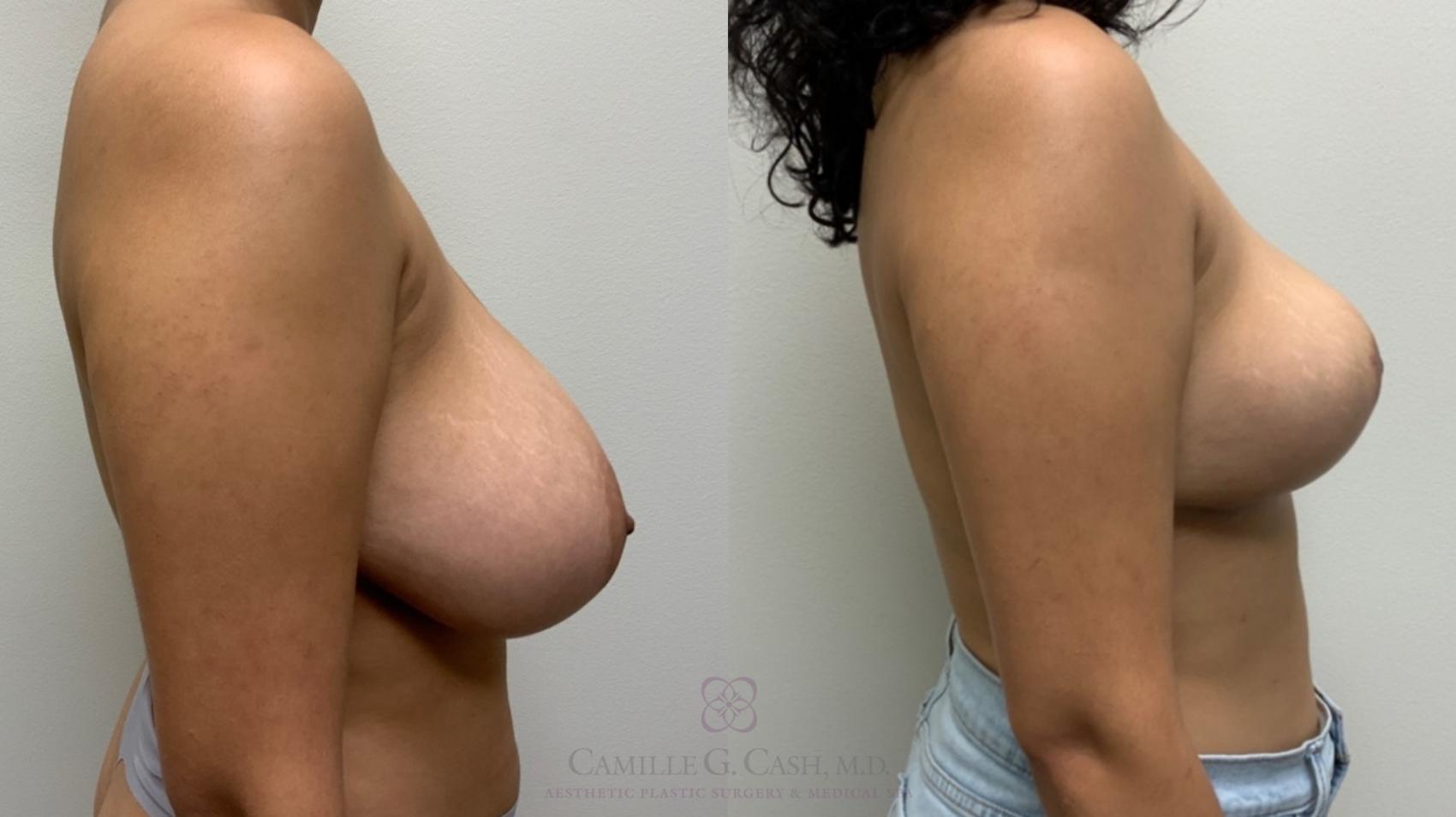 Before & After Breast Reduction Case 544 Left Side View in Houston, TX
