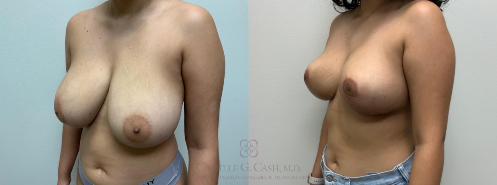 Before & After Breast Reduction Case 544 Right Oblique View in Houston, TX