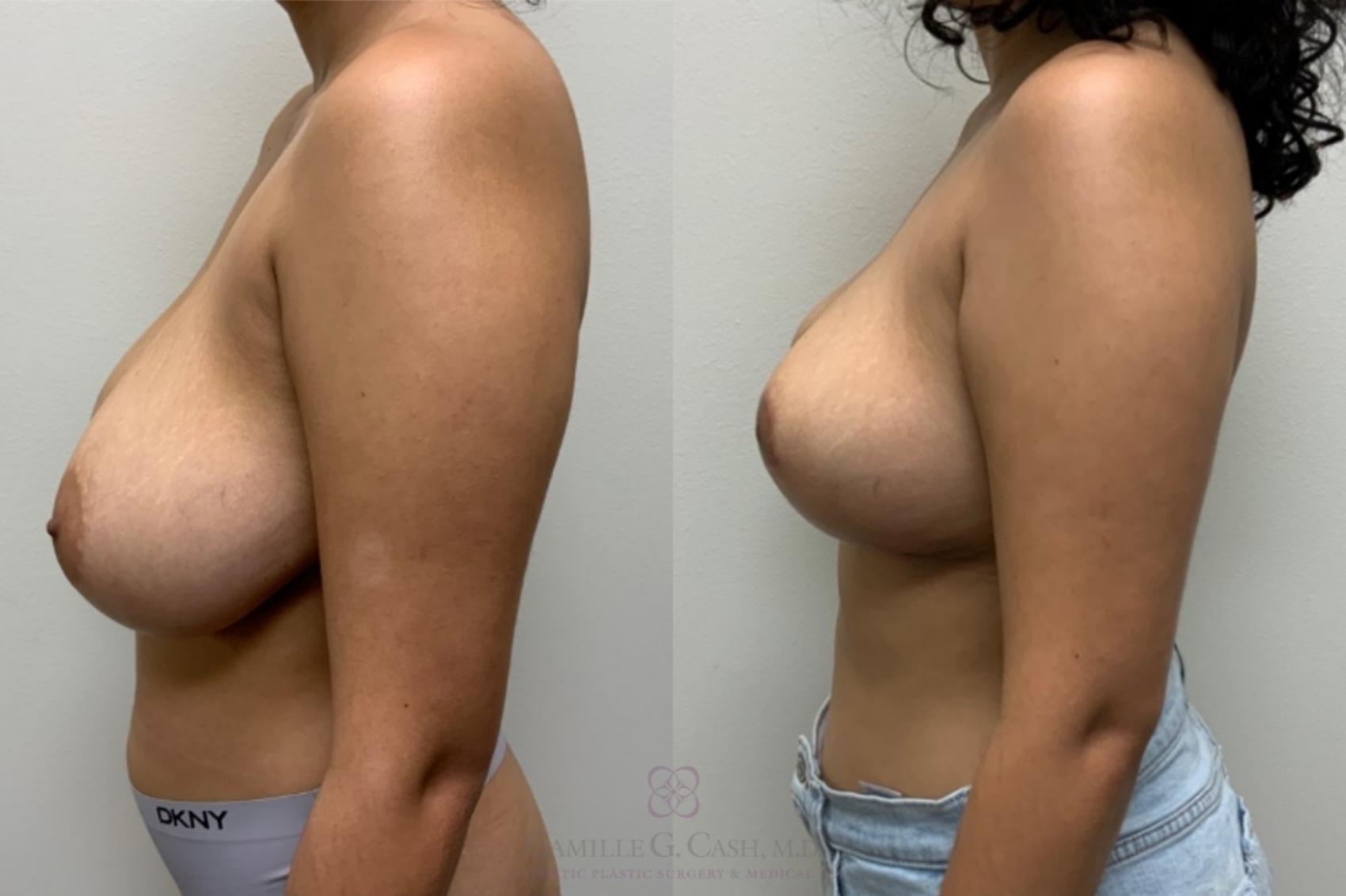 Before & After Breast Reduction Case 544 Right Side View in Houston, TX