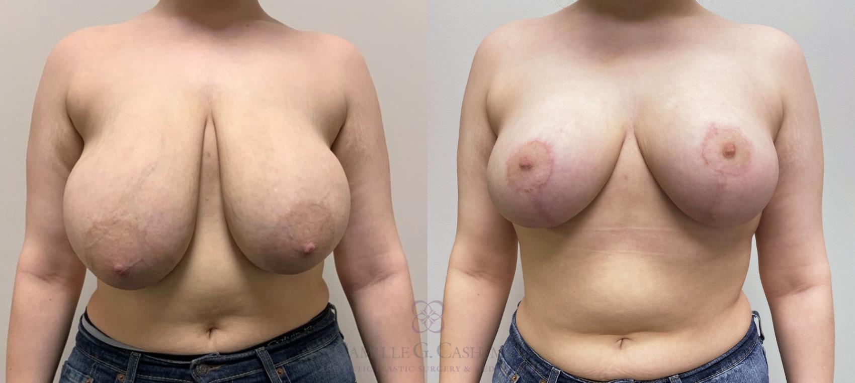 Before & After Breast Reduction Case 551 front 6 months after  View in Houston, TX
