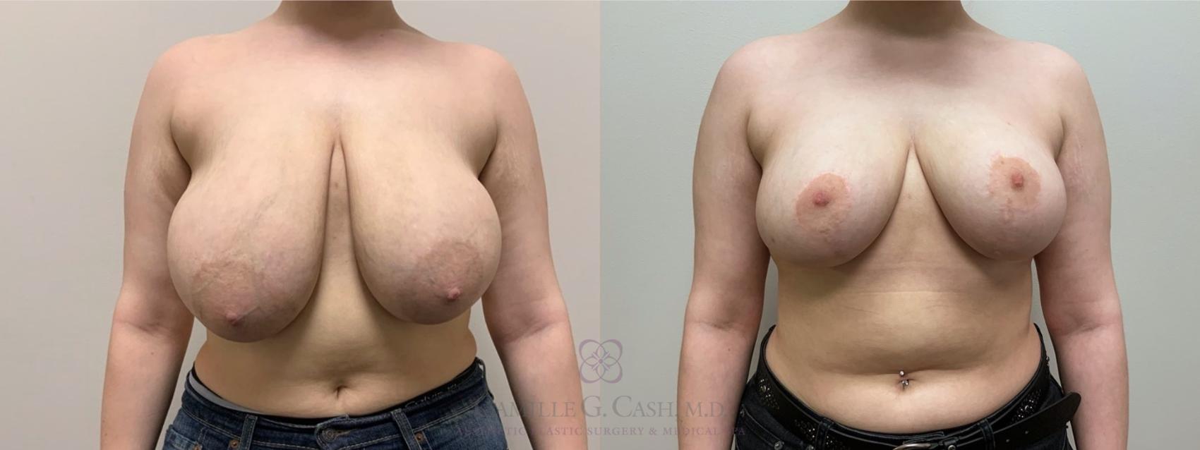 Before & After Breast Reduction Case 551 Front View in Houston, TX