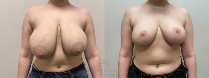 Before & After Breast Reduction Case 551 Front View in Houston, TX