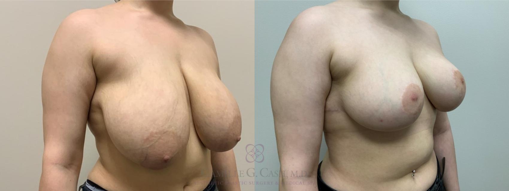 Before & After Breast Reduction Case 551 Left Oblique View in Houston, TX